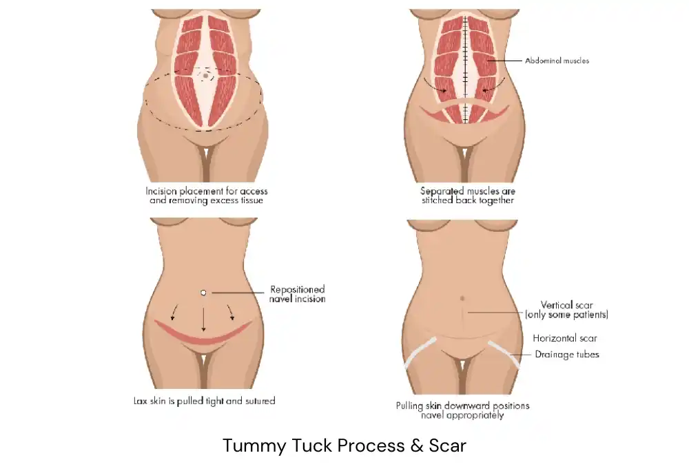 Tummy Tuck Process & Scar
